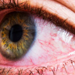Contact Lenses 2