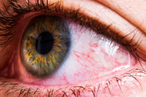 Lian Kao, contact lens, health hazards, effect of contact lens, amoeba, Wu Jian-Lian, omg, avoid contact lens