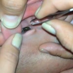 Bug Buried in Guys Ear