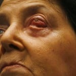tooth in eye women