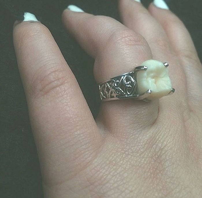 Wisdom tooth, engagement, ring, fiance, carlee leifkes, lucas unger,  weird engagement ring, engagement idea, proposal, amazing, weird, couple, facebook