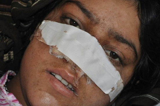 nose cut women 3