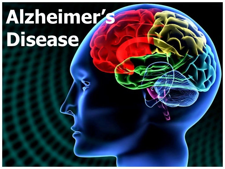 Alzheimers-disease