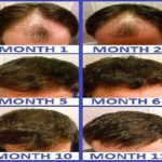 FUE hair transplant turkey 1