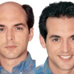 FUE hair transplant turkey 2