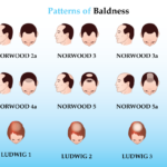 baldness pattern