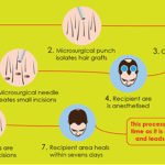 fue hair transplant procedure