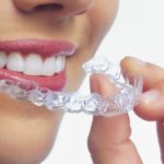 aligners
