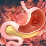 stomach cancer surgery
