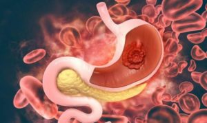 stomach cancer