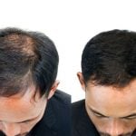 baldness improvement