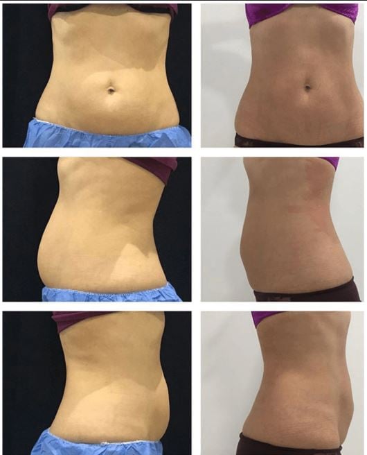 Coolsculpting toronto before and after